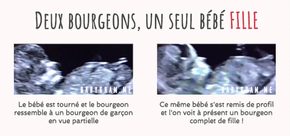 Illustration des limites de la méthode du bourgeon génital : deux bourgeons différents pour un même bébé