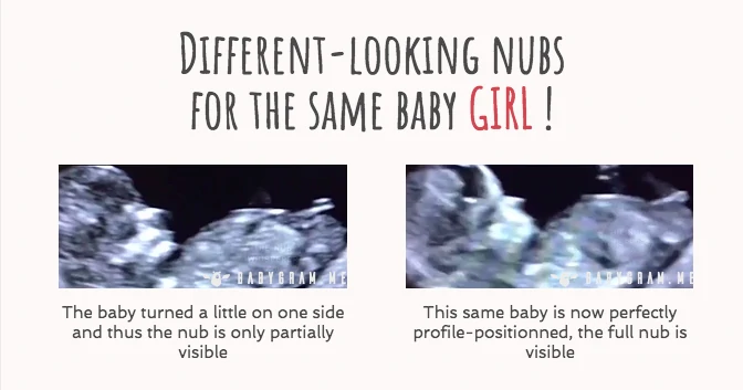 Nub theory can be wrong: different-looking nubs for the same baby girl