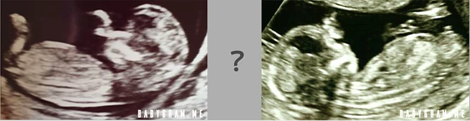 Límites de la teoría del nub: ejemplos poco claros de tubérculo genitalde bebés