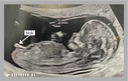 Genital nub example on a fetal ultrasound