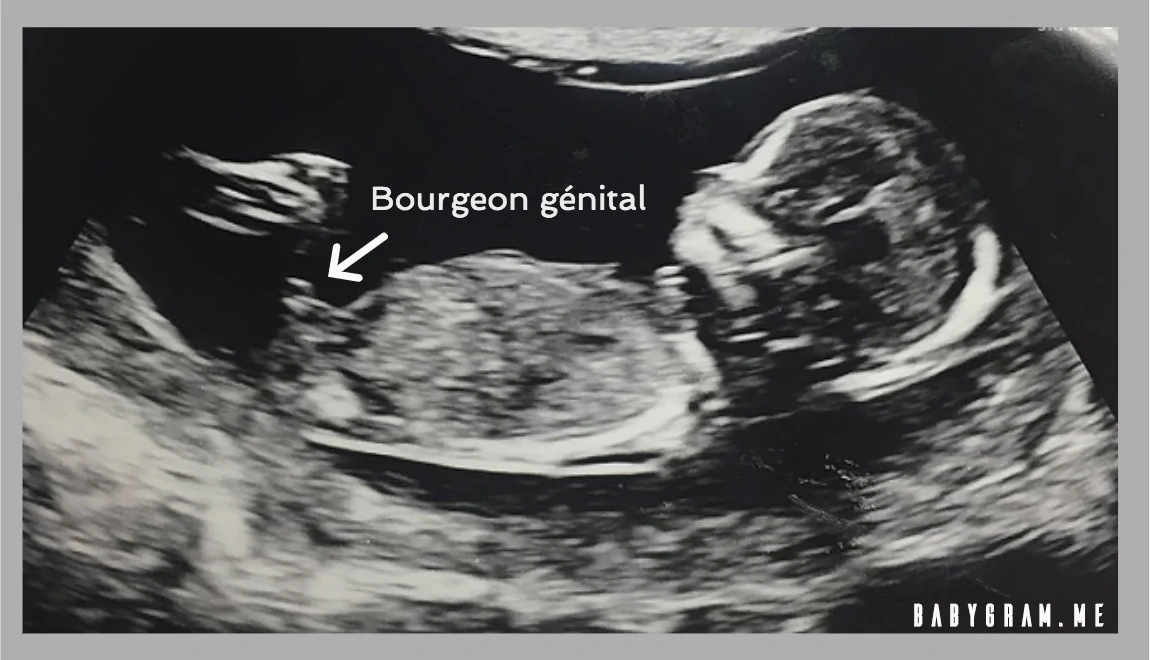 Exemple de bourgeon génital sur une echographie de foetus