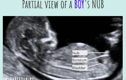 Vista parcial de una tubérculo genital de un niño