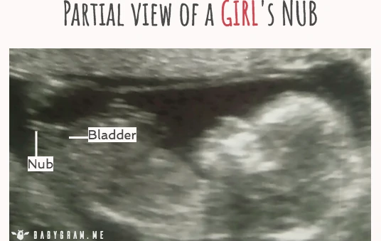 Partial view of a girl's genital nub