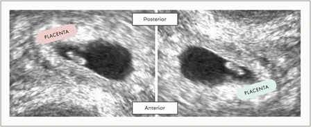 Placenta location according to Ramzi theory